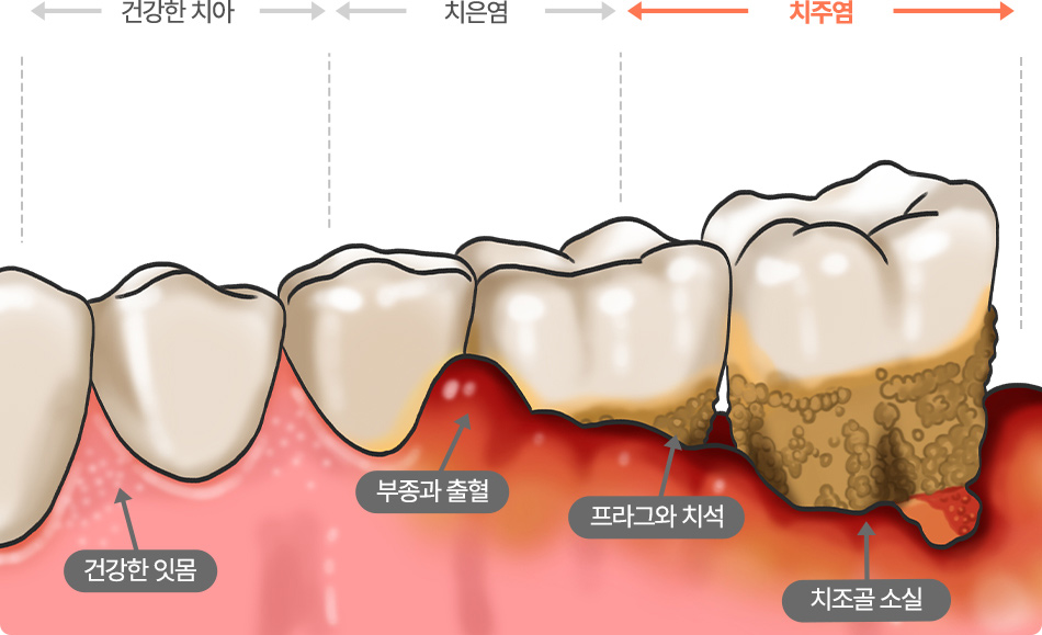 치주질환 진행 단계