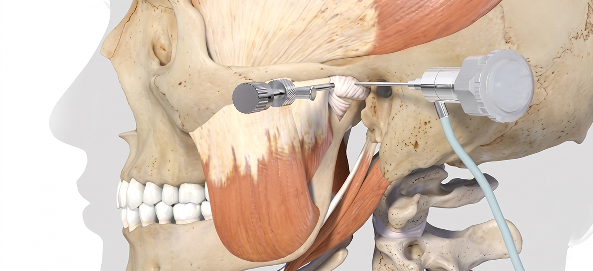 턱관절 세정술